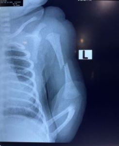 humeral-fracture-2