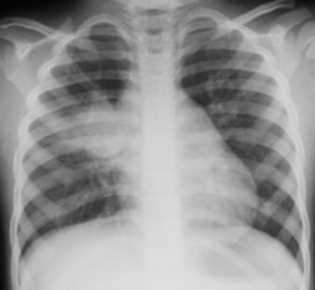 CXR showing PTB