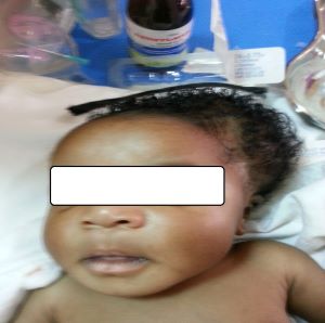 Cephalhematoma