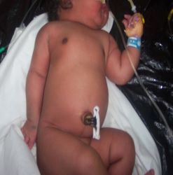 Erb's Palsy