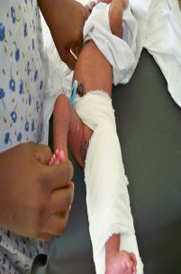 Femoral Fracture Splinting